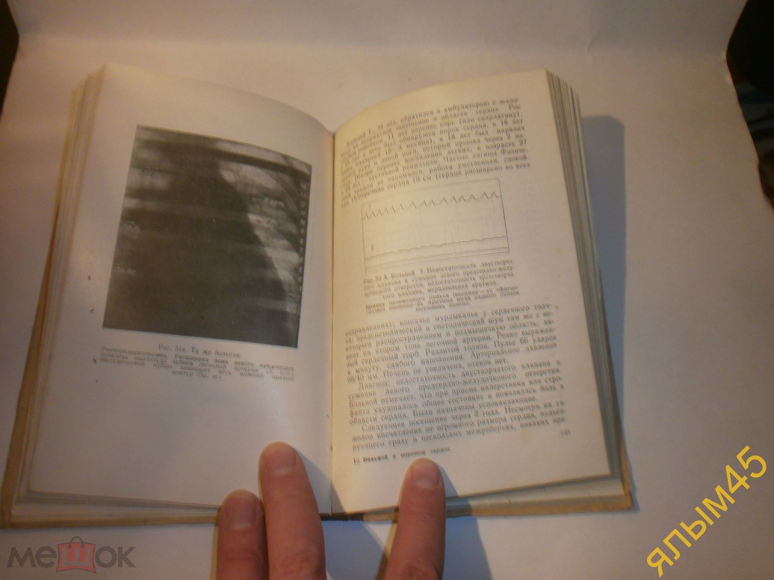 БОЛЬНОЙ С ПОРОКОМ СЕРДЦА В.Ф. Зеленин. 1952 год. МЕДГИЗ СССР Врачам!